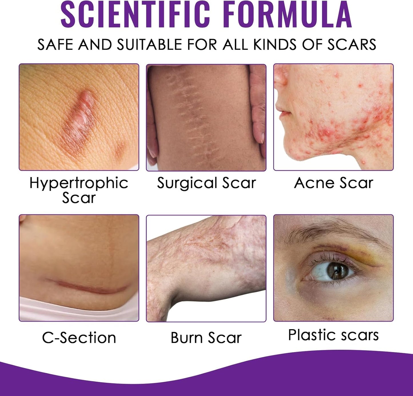 20g Crème Cicatrice, Gel De Cicatrice, Scar gel Réduire et enlever les cicatrices, Pour Cicatrices Anciennes Et Nouvelles, Absorption Rapide, Prendre soin des cicatrice, réparer la peau